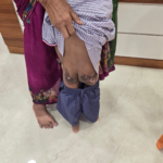 ठाणे में बच्चे को जलाने की अफवाह झूठी निकली, गर्म तवे पर गिरने से झुलसा था 6 वर्षीय मासूम