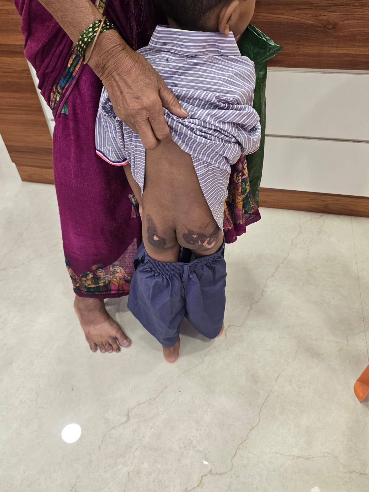 ठाणे में बच्चे को जलाने की अफवाह झूठी निकली, गर्म तवे पर गिरने से झुलसा था 6 वर्षीय मासूम